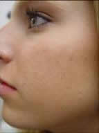 acne treatment after white plains stamford